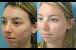 Best Acne Scar Treatment with Fractional CO2 Laser Clinic in Dubai