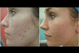 Best Acne Scar Treatment with Fractional CO2 Laser in Dubai