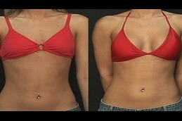 Best Breast Fillers Injections in Dubai