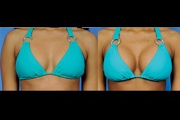 Best Breast Implants in Dubai