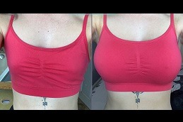 Best Breast Surgery Clinic in Dubai