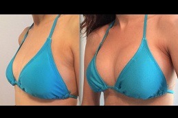 Best Breast Surgery in Dubai