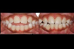Best Clear Aligners Clinic in Dubai & Abu Dhabi