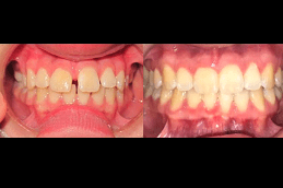 Best Clear Aligners Clinic in Dubai
