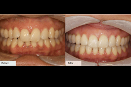 Best Clear Aligners in Dubai