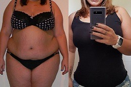 Best Does Gastric Plication Work For Weight Loss Clinic in Dubai & Abu Dhabi