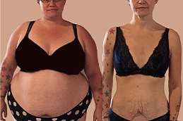 Best Does Gastric Plication Work For Weight Loss Clinic in Dubai