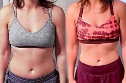 Best Does Gastric Plication Work For Weight Loss in Dubai