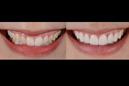 Best Does Hollywood Smile Last Forever Clinic in Dubai & Abu Dhabi