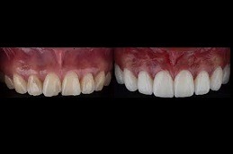 Best Does Hollywood Smile Last Forever Clinic in Dubai
