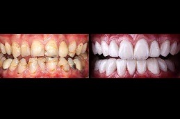 Best Does Hollywood Smile Last Forever in Dubai