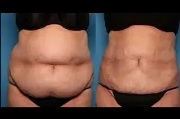 Best Does Liposuction Treatment Leaves A Scar Clinic in Dubai & Abu Dhabi
