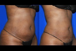 Best Does Liposuction Treatment Leaves A Scar Clinic in Dubai