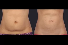 Best Eximia Treatment Non Surgical Fat Reduction Clinic in Dubai & Abu Dhabi