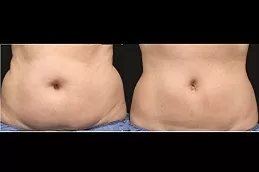 Best Eximia Treatment Non Surgical Fat Reduction Clinic in Dubai