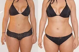 Best Eximia Treatment Non Surgical Fat Reduction in Dubai