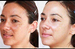 Best Glutathione Pills For Skin Whitening Clinic in Dubai