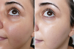 Best Glutathione Pills For Skin Whitening in Dubai