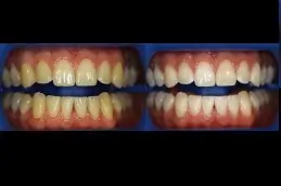 Best Home Teeth Whitening Clinic in Dubai & Abu Dhabi