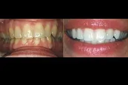 Best Home Teeth Whitening Clinic in Dubai