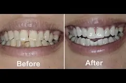 Best Home Teeth Whitening in Dubai