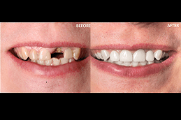 Best Is Extraction Of A Tooth a Better Alternative To Root Canal Treatment Clinic in Dubai & Abu Dhabi
