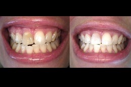 Best Is Extraction Of A Tooth a Better Alternative To Root Canal Treatment Clinic in Dubai