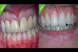 Best Is Extraction Of A Tooth a Better Alternative To Root Canal Treatment in Dubai