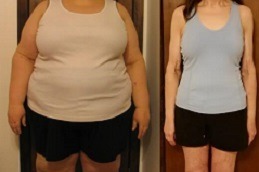 Best Is Gastric Bypass A Permanent Weight Loss Procedure in Dubai