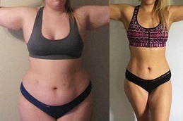 Best Is Weight Loss With The Mini Gastric Bypass Safe Clinic in Dubai & Abu Dhabi