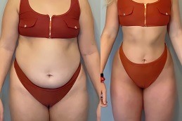 Best Is Weight Loss With The Mini Gastric Bypass Safe Clinic in Dubai