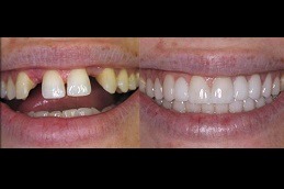 Best Surgical Tooth Removal Clinic in Dubai & Abu Dhabi