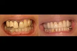 Best Surgical Tooth Removal in Dubai