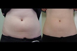 Best Ultrasound Cavitation Clinic in Dubai & Abu Dhabi