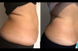 Best Ultrasound Cavitation Clinic in Dubai