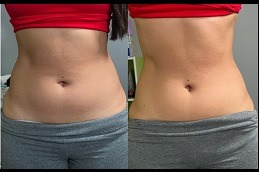 Best Ultrasound Cavitation in Dubai