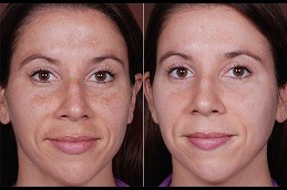 Best VISIA Skin Analysis Clinic in Dubai & Abu Dhabi