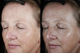 Best VISIA Skin Analysis Clinic in Dubai