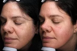 Best VISIA Skin Analysis in Dubai