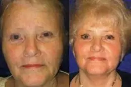 Best What Are The Advantages Of Laser Skin Resurfacing Clinic in Dubai & Abu Dhabi