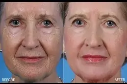Best What Are The Advantages Of Laser Skin Resurfacing Clinic in Dubai