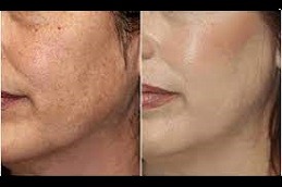 Best What Are The Advantages Of Laser Skin Resurfacing in Dubai