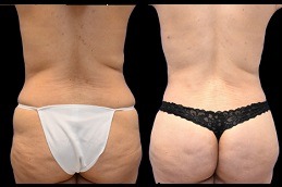 Best Where Can You Find A Buttocks Lift Clinic in Dubai & Abu Dhabi