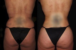 Best Where Can You Find A Buttocks Lift Clinic in Dubai