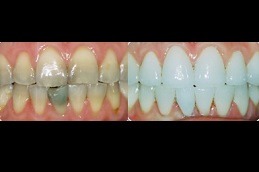 Best Why Do We Need Cosmetic Dentistry Treatments in Dubai