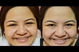 Acne treatment in Dubai