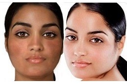 Why Does Glutathione Cause Acne Breakouts in Dubai