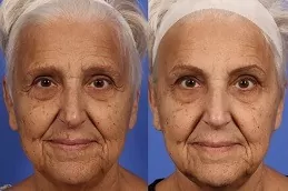 Best Xeomin Treatment Clinic in Dubai