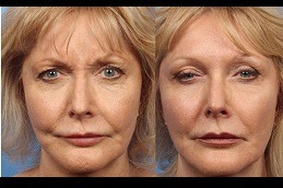 Best Xeomin Treatment in Dubai