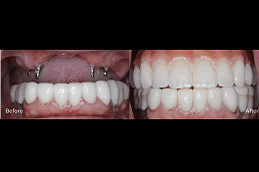Best Zygomatic Implants Clinic in Dubai & Abu Dhabi